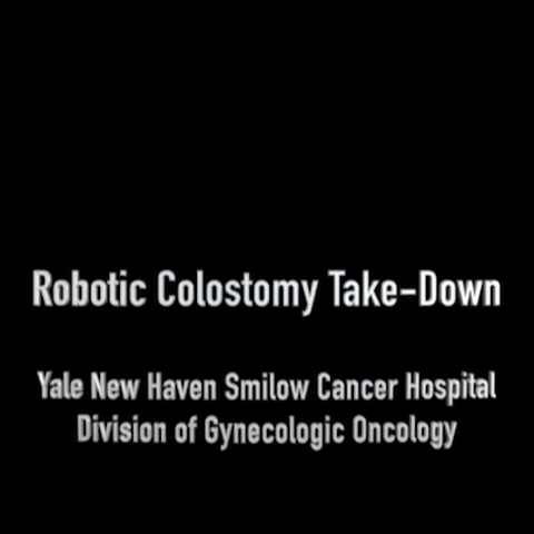 Robotic-Colostomy-Video-Thumb