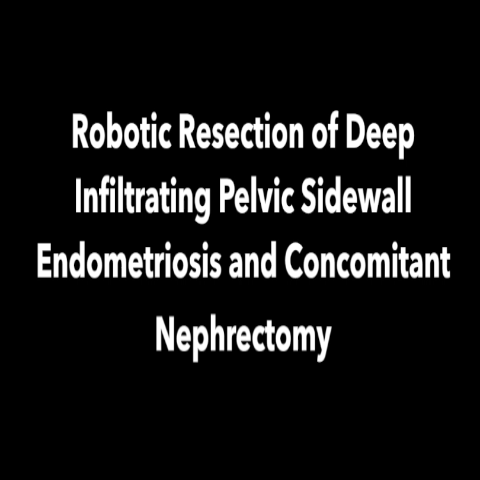 Robotic-Resection-Deep-Infiltrating-Pelvic-Sidewall-Endometriosis-Concomitant-Nephrectomy-thumb